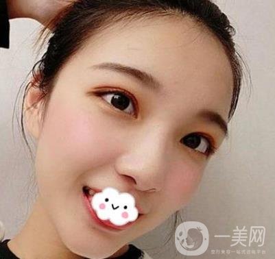 北京安貞醫(yī)院整容怎么樣？李斌斌修復雙眼皮怎么樣？內(nèi)含案例及價格表