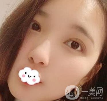 北京安貞醫(yī)院整容怎么樣？李斌斌修復雙眼皮怎么樣？內(nèi)含案例及價格表