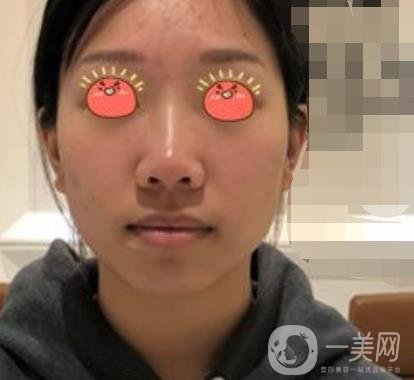 廣東省人民醫(yī)院隆鼻案例及整形價格表分享