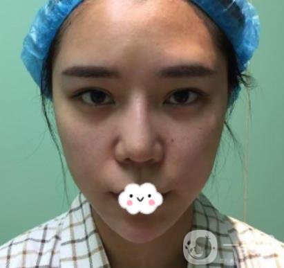 師俊莉脂肪填充面部