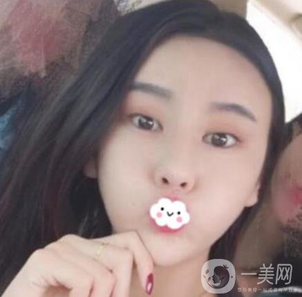 師俊莉脂肪填充面部