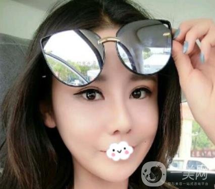 師俊莉脂肪填充面部