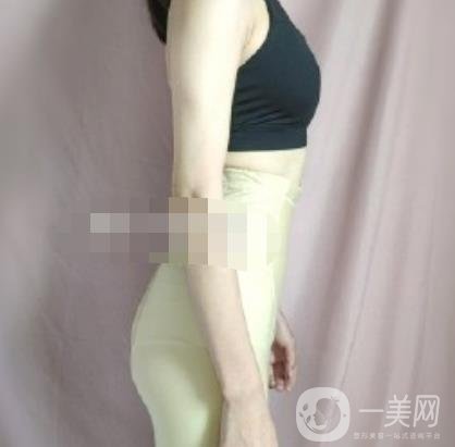 安陽(yáng)地區(qū)醫(yī)院抽脂