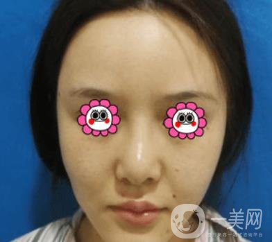 長(zhǎng)沙中南大學(xué)*三醫(yī)院整形美容外科隆鼻多少錢？?jī)r(jià)格表及案例詳情
