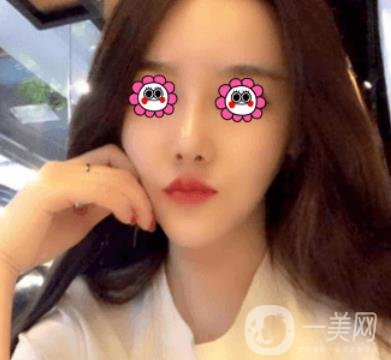 長(zhǎng)沙中南大學(xué)*三醫(yī)院整形美容外科隆鼻多少錢？?jī)r(jià)格表及案例詳情