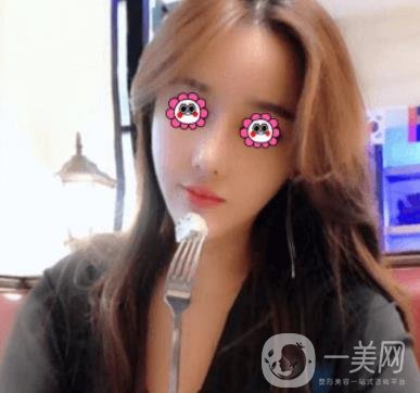 長(zhǎng)沙中南大學(xué)*三醫(yī)院整形美容外科隆鼻多少錢？?jī)r(jià)格表及案例詳情