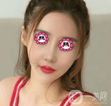 長(zhǎng)沙中南大學(xué)*三醫(yī)院整形美容外科隆鼻多少錢？?jī)r(jià)格表及案例詳情