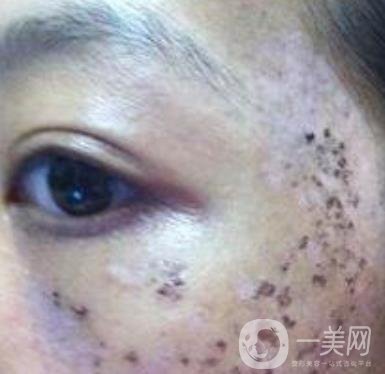 解放軍總醫(yī)院整形美容科*新價(jià)格表發(fā)布,附祛斑案例日記分享