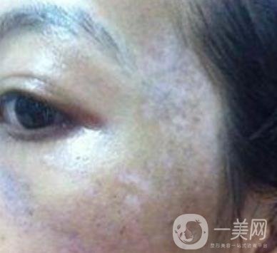 解放軍總醫(yī)院整形美容科*新價(jià)格表發(fā)布,附祛斑案例日記分享