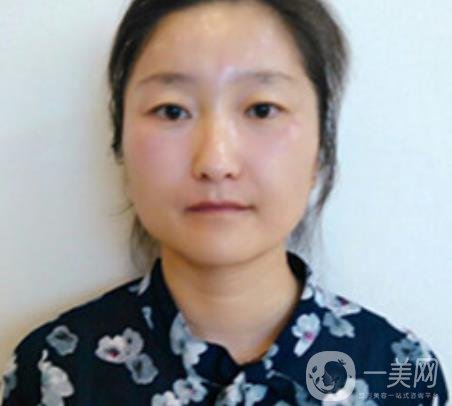 龍崗中心醫(yī)院整形外科價格表（收費(fèi)）,附去斑案例詳情