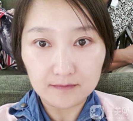 龍崗中心醫(yī)院整形外科價格表（收費(fèi)）,附去斑案例詳情