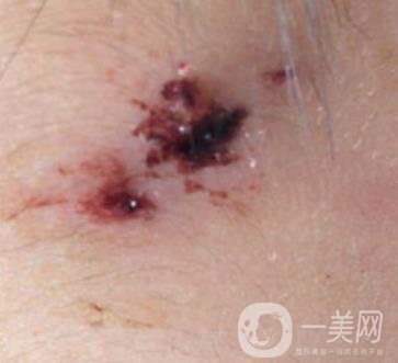 泰安市中心醫(yī)院美容整形科價(jià)格表,附祛疤案例*果分享