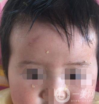 泰安市中心醫(yī)院美容整形科價(jià)格表,附祛疤案例*果分享