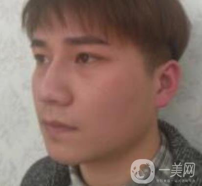 棗莊市立醫(yī)院燒傷整形美容科做光子嫩膚好嗎？價格表及術(shù)后*果分享