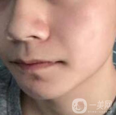 棗莊市立醫(yī)院燒傷整形美容科做光子嫩膚好嗎？價格表及術(shù)后*果分享