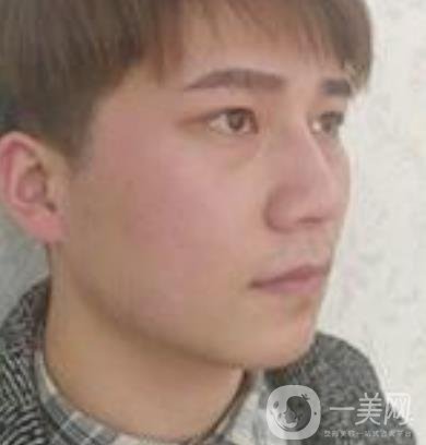 棗莊市立醫(yī)院燒傷整形美容科做光子嫩膚好嗎？價格表及術(shù)后*果分享