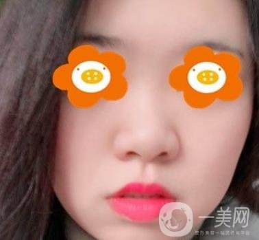 重慶西南醫(yī)院整形外科價格表2020_自體脂肪填充鼻部案例