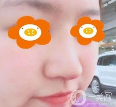 重慶西南醫(yī)院整形外科價格表2020_自體脂肪填充鼻部案例