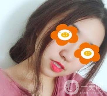 重慶西南醫(yī)院整形外科價格表2020_自體脂肪填充鼻部案例