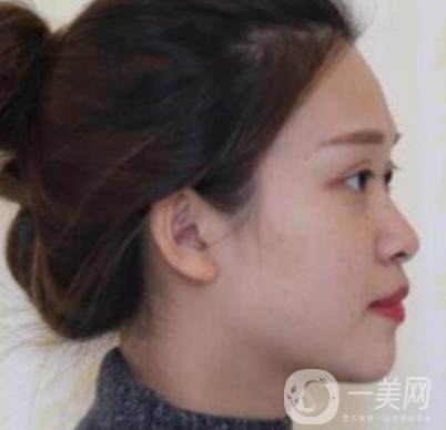 臨沂市人民醫(yī)院價格表2020_雙眼皮案例分享