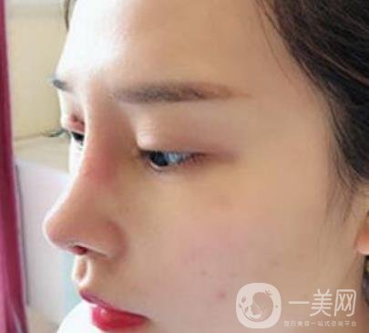 臨沂市人民醫(yī)院價格表2020_雙眼皮案例分享