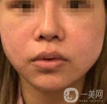 四川省人民醫(yī)院整形外科游曉波磨骨怎么樣?價格收費明細表一覽