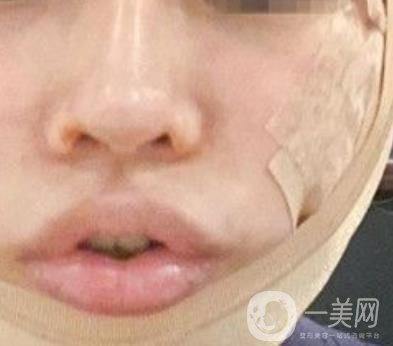 四川省人民醫(yī)院整形外科游曉波磨骨怎么樣?價格收費明細表一覽