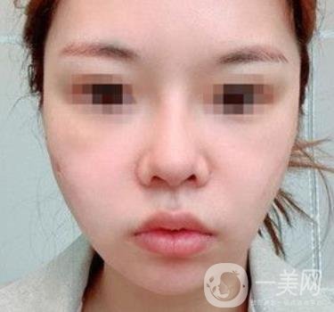 四川省人民醫(yī)院整形外科游曉波磨骨怎么樣?價格收費明細表一覽