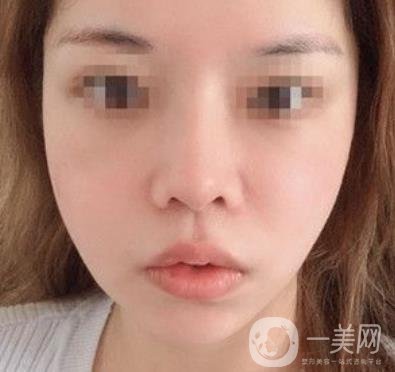 四川省人民醫(yī)院整形外科游曉波磨骨怎么樣?價格收費明細表一覽