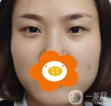 成都*做雙眼皮前后*果圖，附整形美容科價(jià)格收費(fèi)表一覽