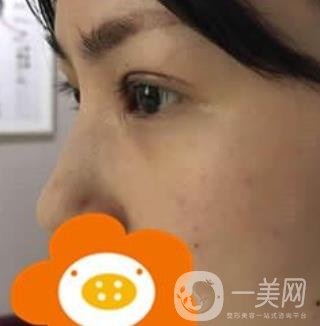 成都*做雙眼皮前后*果圖，附整形美容科價(jià)格收費(fèi)表一覽