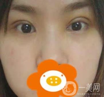 成都*做雙眼皮前后*果圖，附整形美容科價(jià)格收費(fèi)表一覽