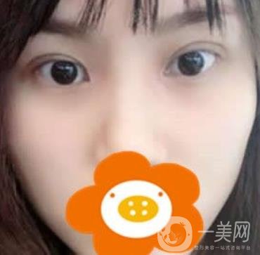 成都*做雙眼皮前后*果圖，附整形美容科價(jià)格收費(fèi)表一覽