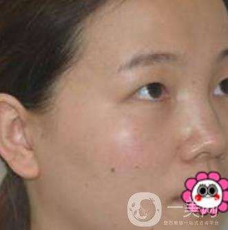 河南省人民醫(yī)院誰(shuí)做雙眼皮好？附案例及2020整形價(jià)格表