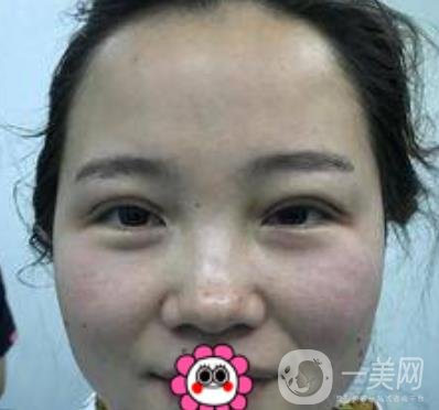 河南省人民醫(yī)院誰(shuí)做雙眼皮好？附案例及2020整形價(jià)格表