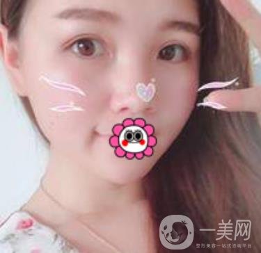 河南省人民醫(yī)院誰(shuí)做雙眼皮好？附案例及2020整形價(jià)格表