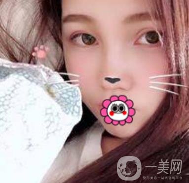 河南省人民醫(yī)院誰(shuí)做雙眼皮好？附案例及2020整形價(jià)格表