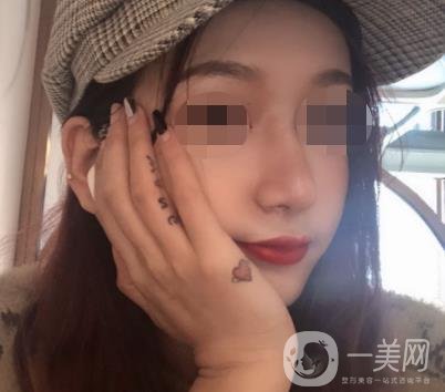 遼寧省人民醫(yī)院美容科怎么樣？附袁繼龍隆鼻案例