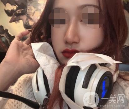 遼寧省人民醫(yī)院美容科怎么樣？附袁繼龍隆鼻案例