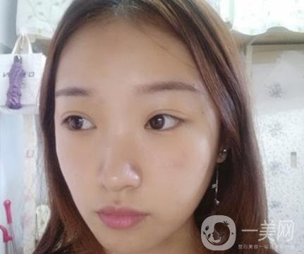 北大醫(yī)院美容價(jià)格表，附自體脂肪填充面部前后照