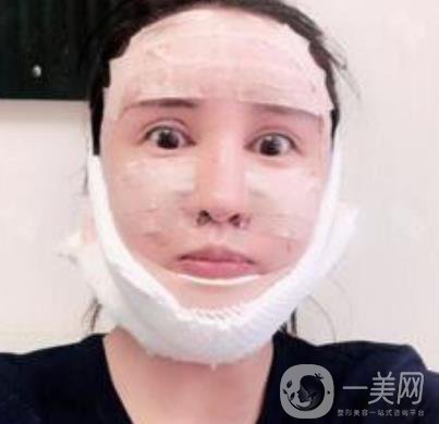 北大醫(yī)院美容價(jià)格表，附自體脂肪填充面部前后照