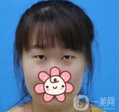 2020浙江省人民醫(yī)院整形價(jià)格表，附雙眼皮案例