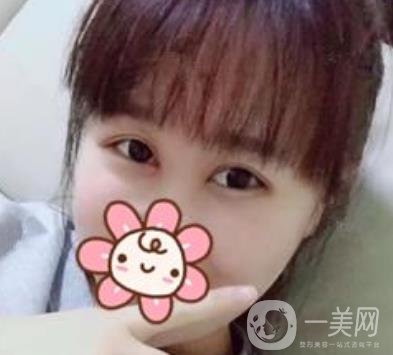 2020浙江省人民醫(yī)院整形價(jià)格表，附雙眼皮案例