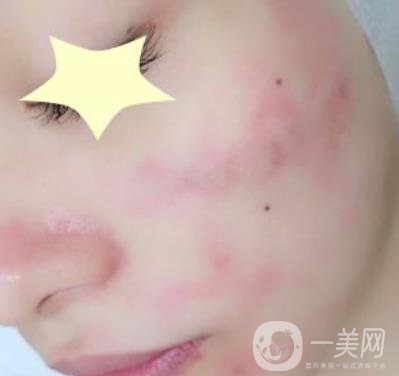 珠海中西醫(yī)結(jié)合醫(yī)院整形價格表及激光祛斑案例一覽