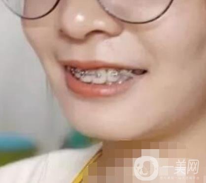 福建醫(yī)大口腔醫(yī)院整牙