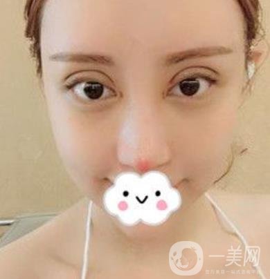 交大一附院何林做雙眼皮好嗎？價格表及術(shù)后*果分享