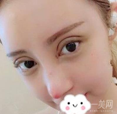 交大一附院何林做雙眼皮好嗎？價格表及術(shù)后*果分享