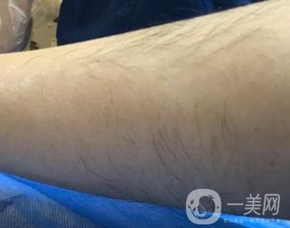 廈門中醫(yī)院陳華脫毛靠譜嗎？價(jià)格表及案例*果一覽