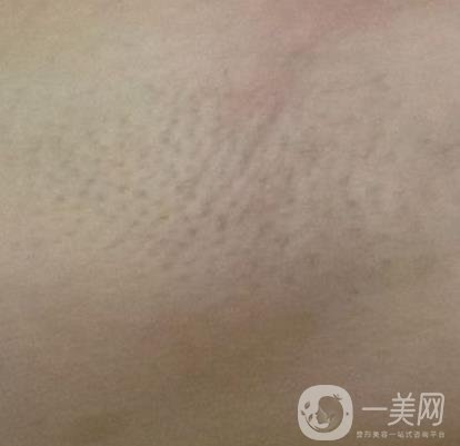 廈門中醫(yī)院陳華脫毛靠譜嗎？價(jià)格表及案例*果一覽