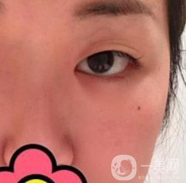 山大二院整形科2020價格表公布,附雙眼皮案例術后*果圖